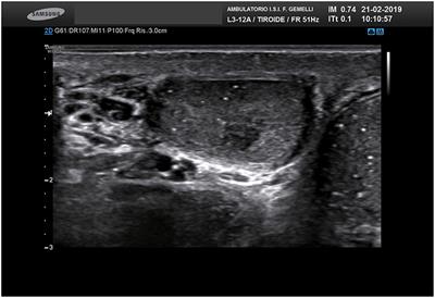 Germ Cell Neoplasia in situ (GCNIS) in Testis-Sparing Surgery (TSS) for Small Testicular Masses (STMs)